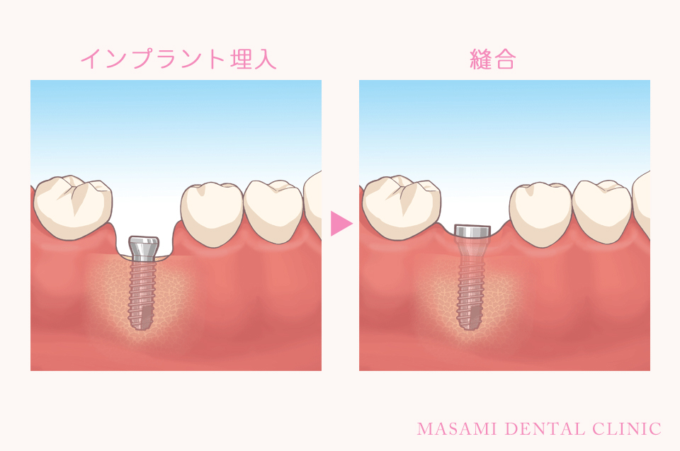 インプラント治療説明