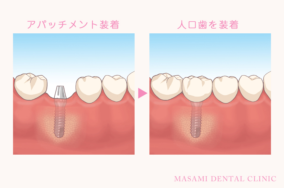 インプラント治療説明２